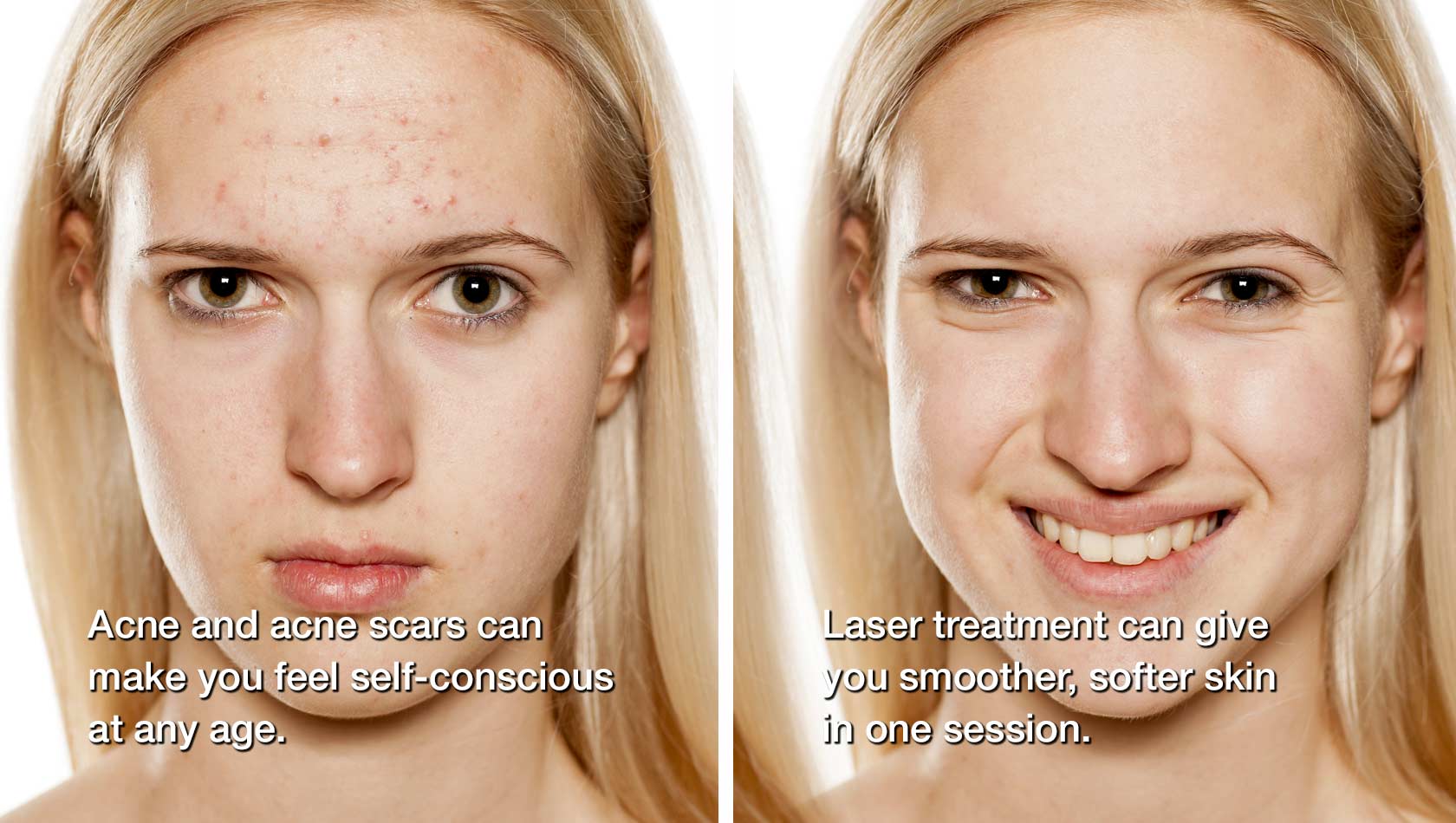 before woman with acne with text reading: acne and acne scars can make you feel self-conscious at any age and after woman with clear skin with text reading: laser treatment can give you smoother, softer skin in one session